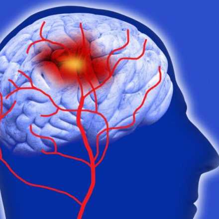 illustration of stroke in blood vessels of the brain